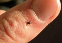 Rickettsia Outbreak in Durango’s Laguna Region Claims Three Lives Amid Five Confirmed Cases