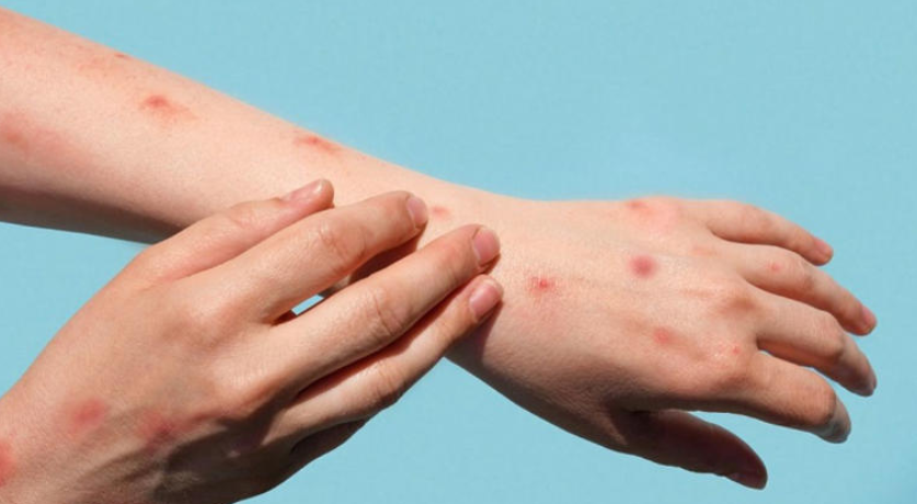Durango records 607 measles cases and Coahuila 167 in 2026.
